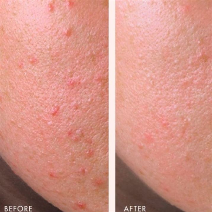 Avene Cleanance Comedomed Peeling Cream 40ml