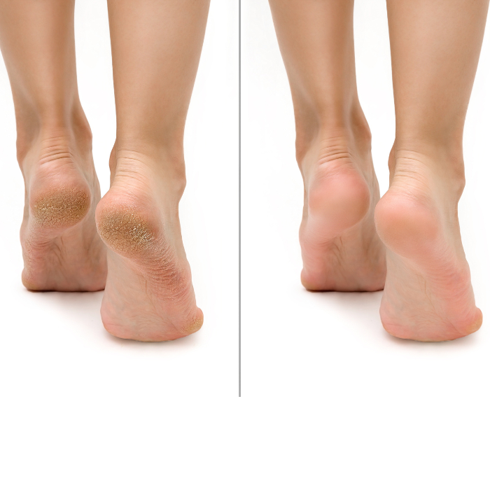 Feetcalm Callus & Hard Skin 20% Urea Spray 300ml