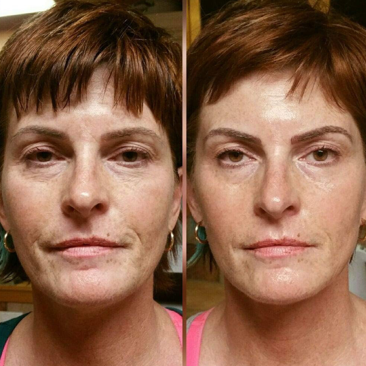 Fillerina Plus Filler Treatment Grade 5 30ml 2s