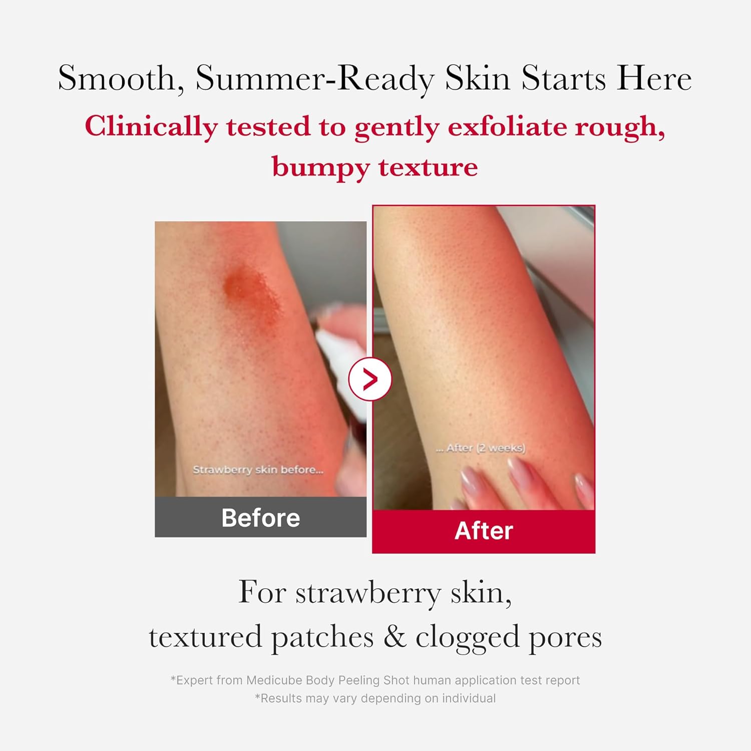 Medicube Red Acne Body Peeling Shot, AHA BHA PHA LHA Exfoliant Spray for Breakouts, 110g