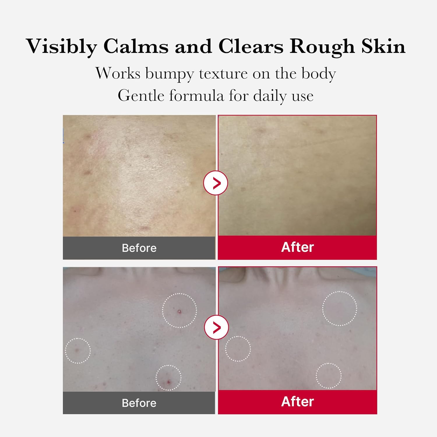 Medicube Red Acne Body Peeling Shot, AHA BHA PHA LHA Exfoliant Spray for Breakouts, 110g